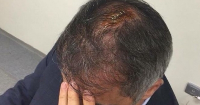 Şenol Güneşin başına tikiş vuruldu Şenol Güneşin başına tikiş vuruldu